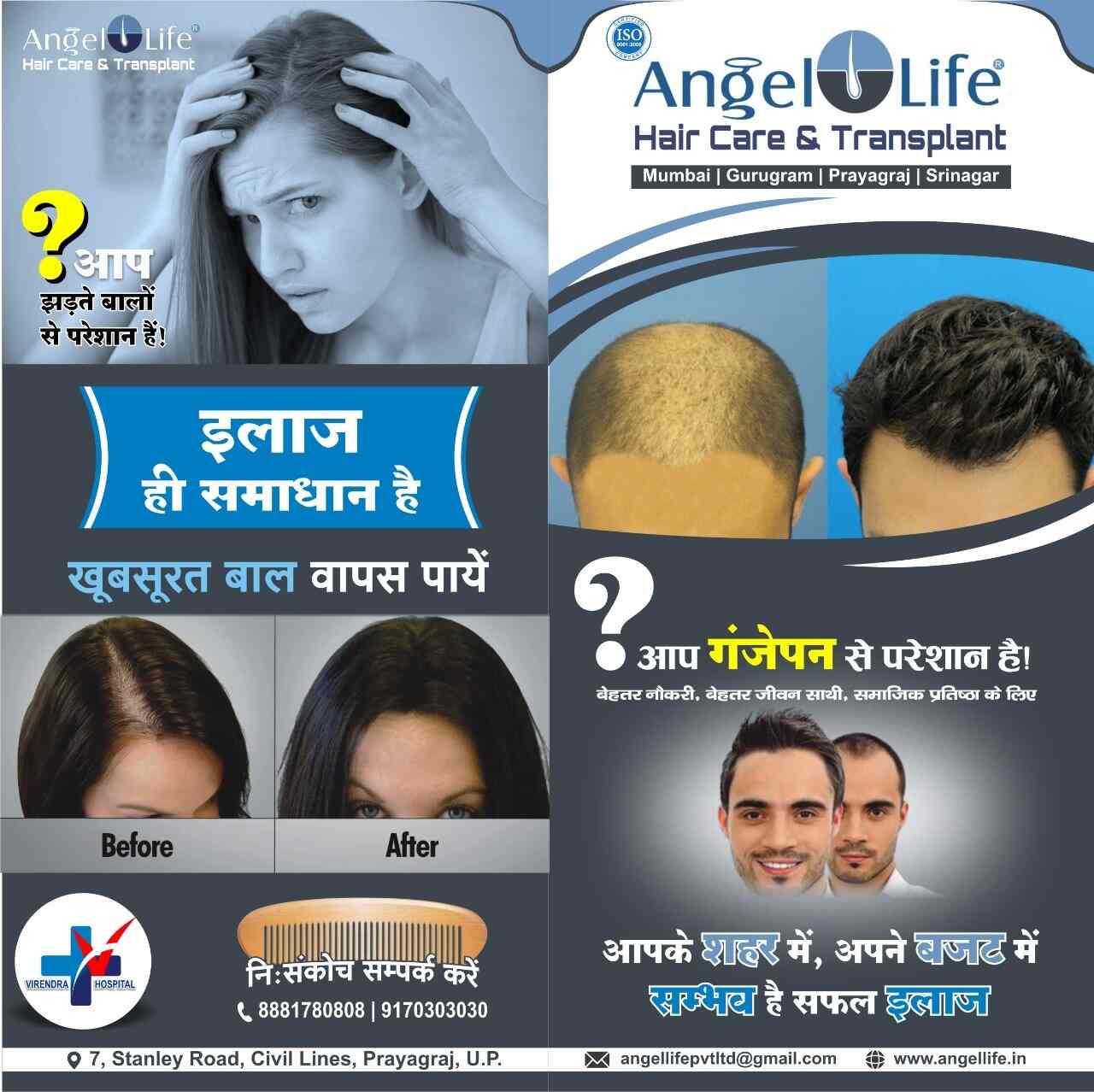 Top more than 140 hair transplant in allahabad best tnbvietnam.edu.vn