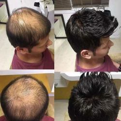 Abhishek Hair Weaving Center Ramnagar Wig Dealers In Anantapur