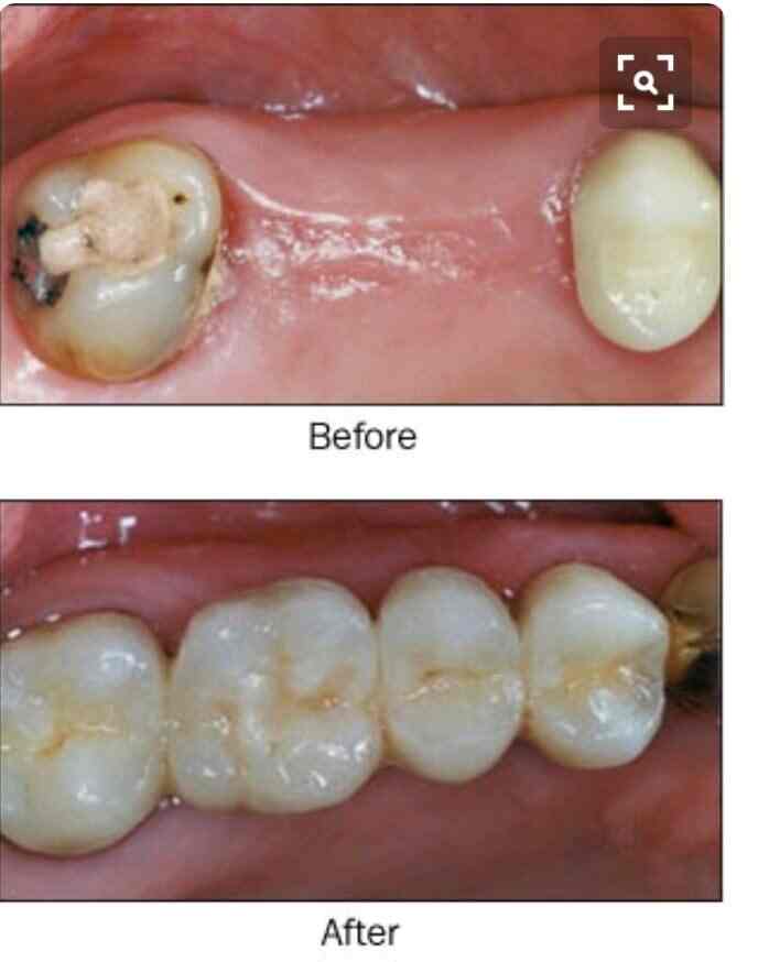 Cost Of Wisdom Teeth Removal Aspen Dental TeethWalls