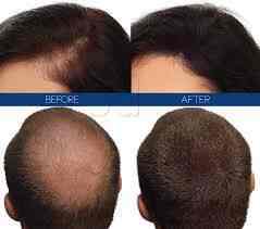 Naturally Beautiful Hair Fibre Nagawara Salons In Bangalore