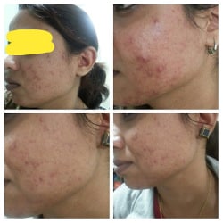 skin care clinic in vidyaranyapura