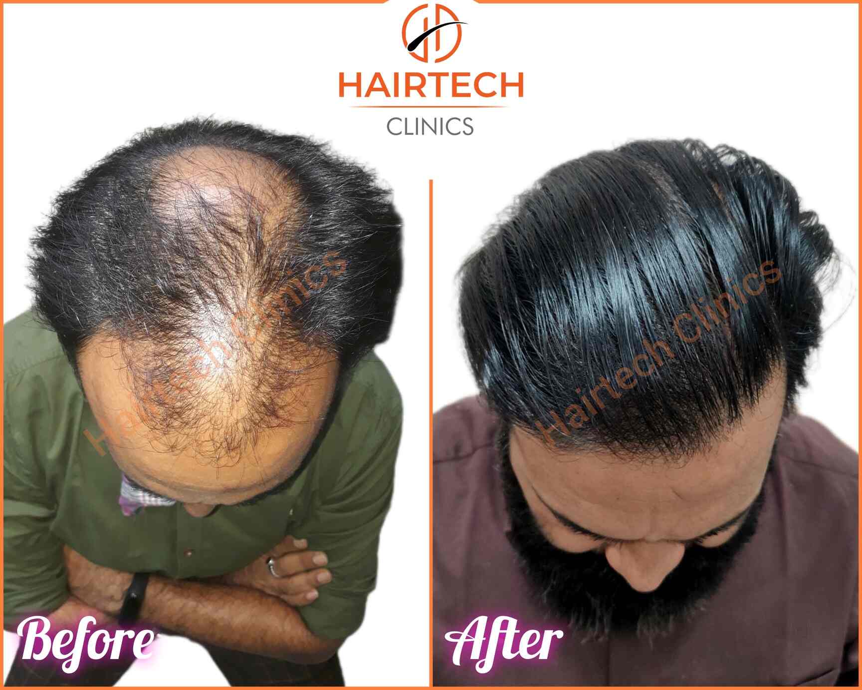 Details more than 144 enhance hair transplant lucknow best POPPY