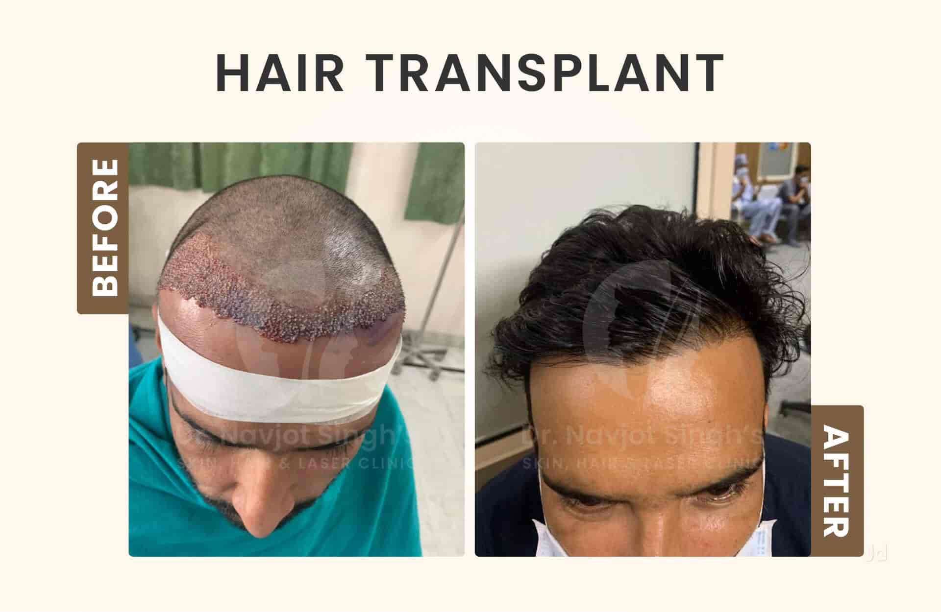 Share 164+ hair transplant reversal latest ceg.edu.vn