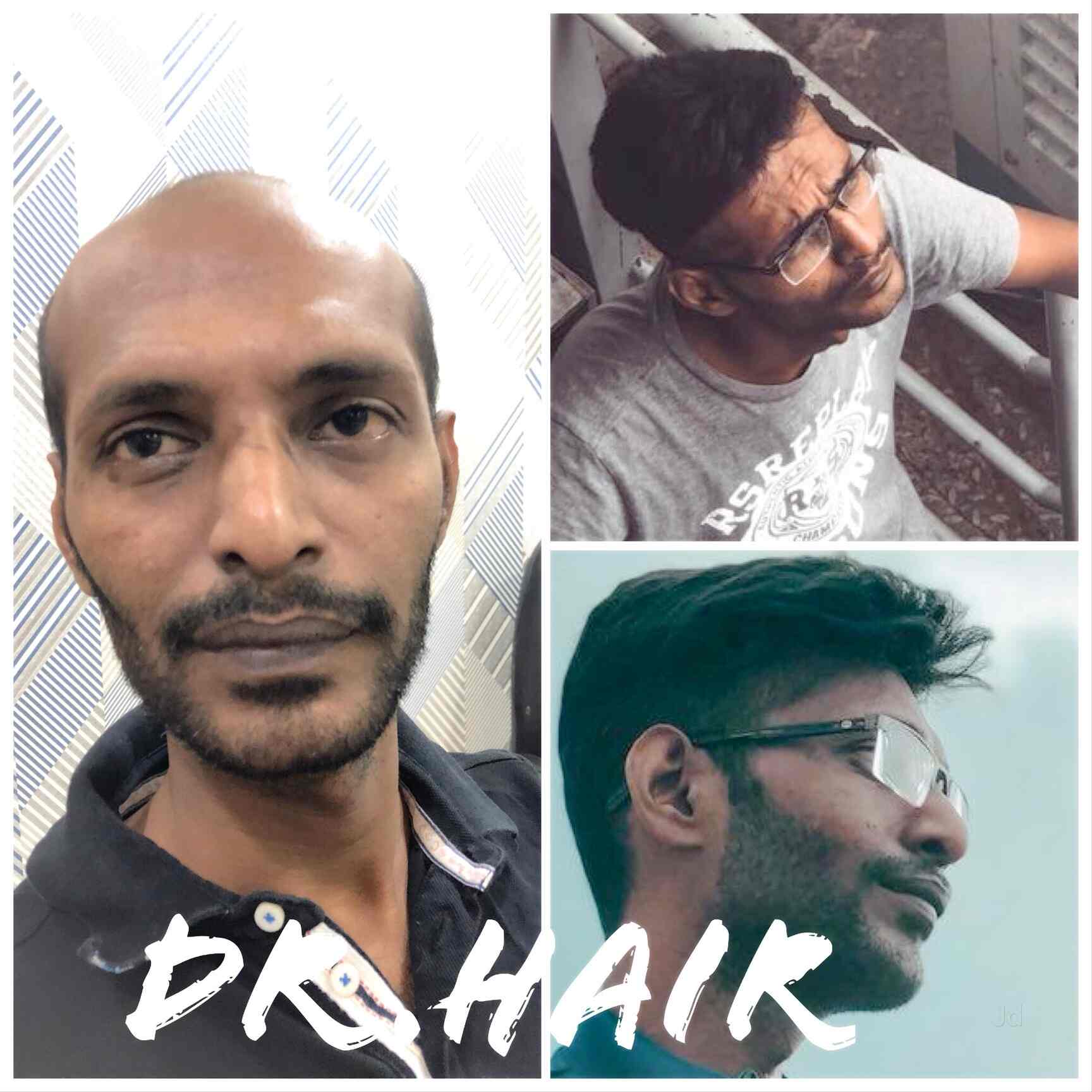 Share 138+ prp hair treatment in chennai best camera.edu.vn