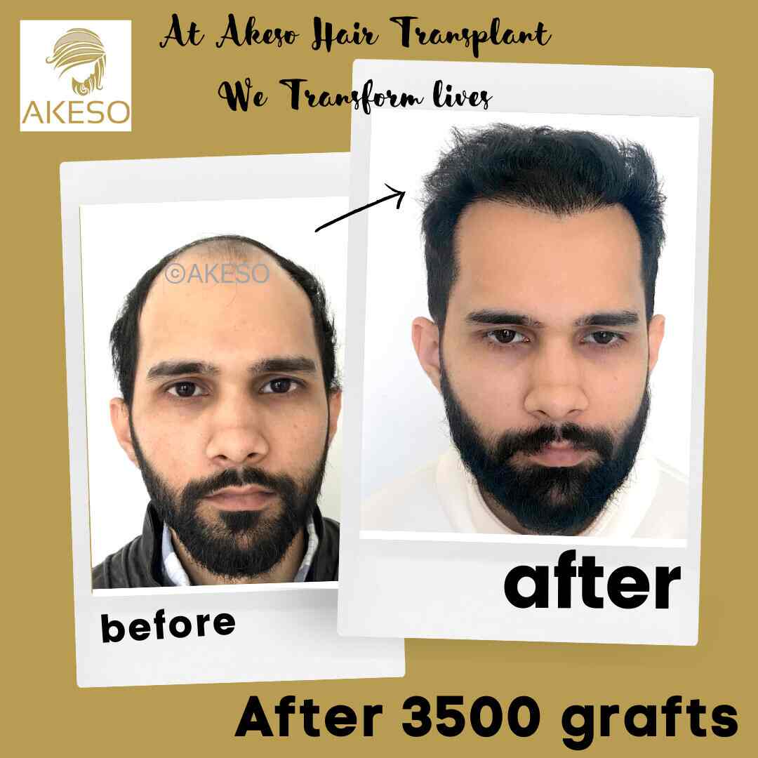 Top more than 144 hair transplant surgery in delhi best tnbvietnam.edu.vn
