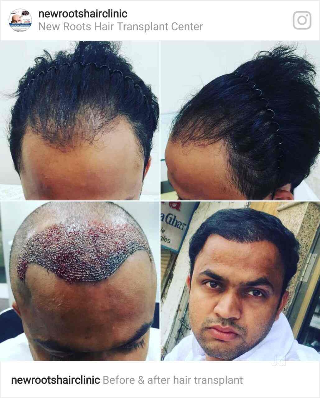 New Roots Hair Transplant Centre Hair Treatment Clinics Book
