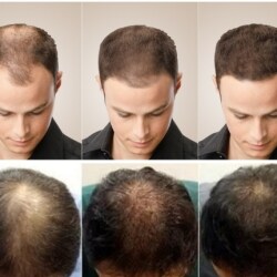 Happy Hair Weaving Center Hair Loss Doctors Book Appointment