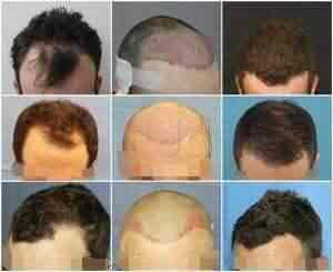 Vcare Super Speciality Hair Clinic Banjara Hills Hair Treatment