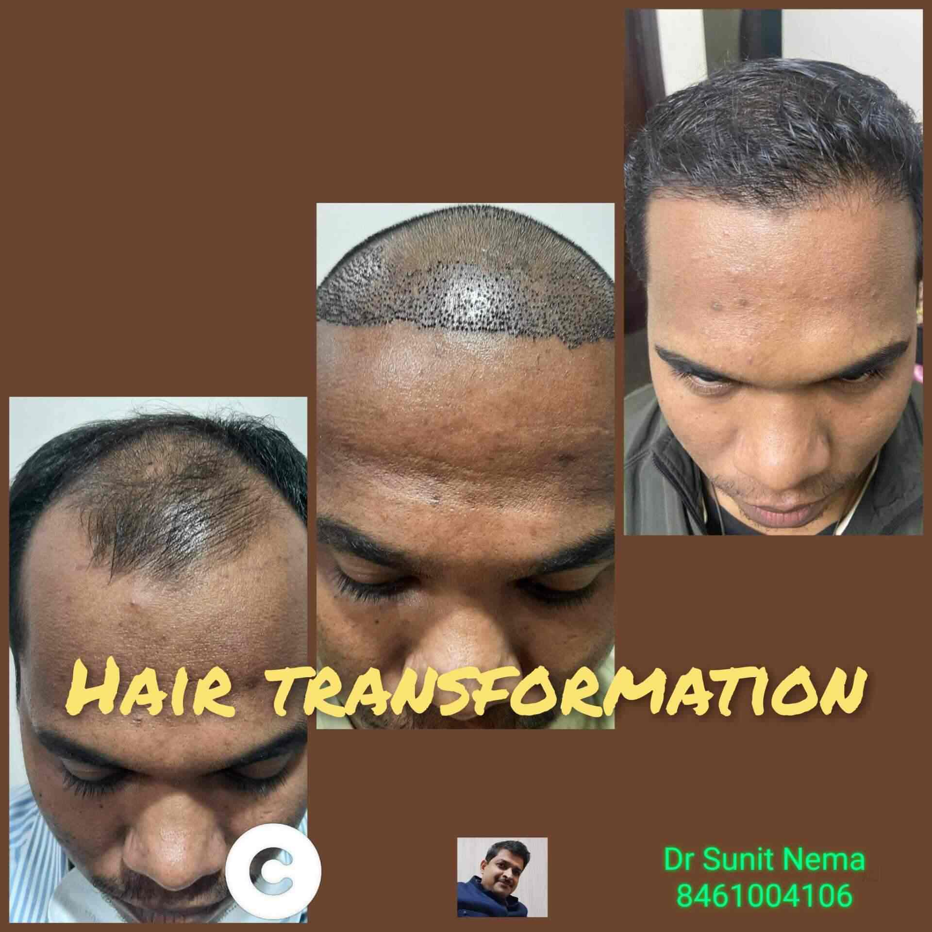 Discover more than 58 hair transplant in jabalpur latest in.eteachers