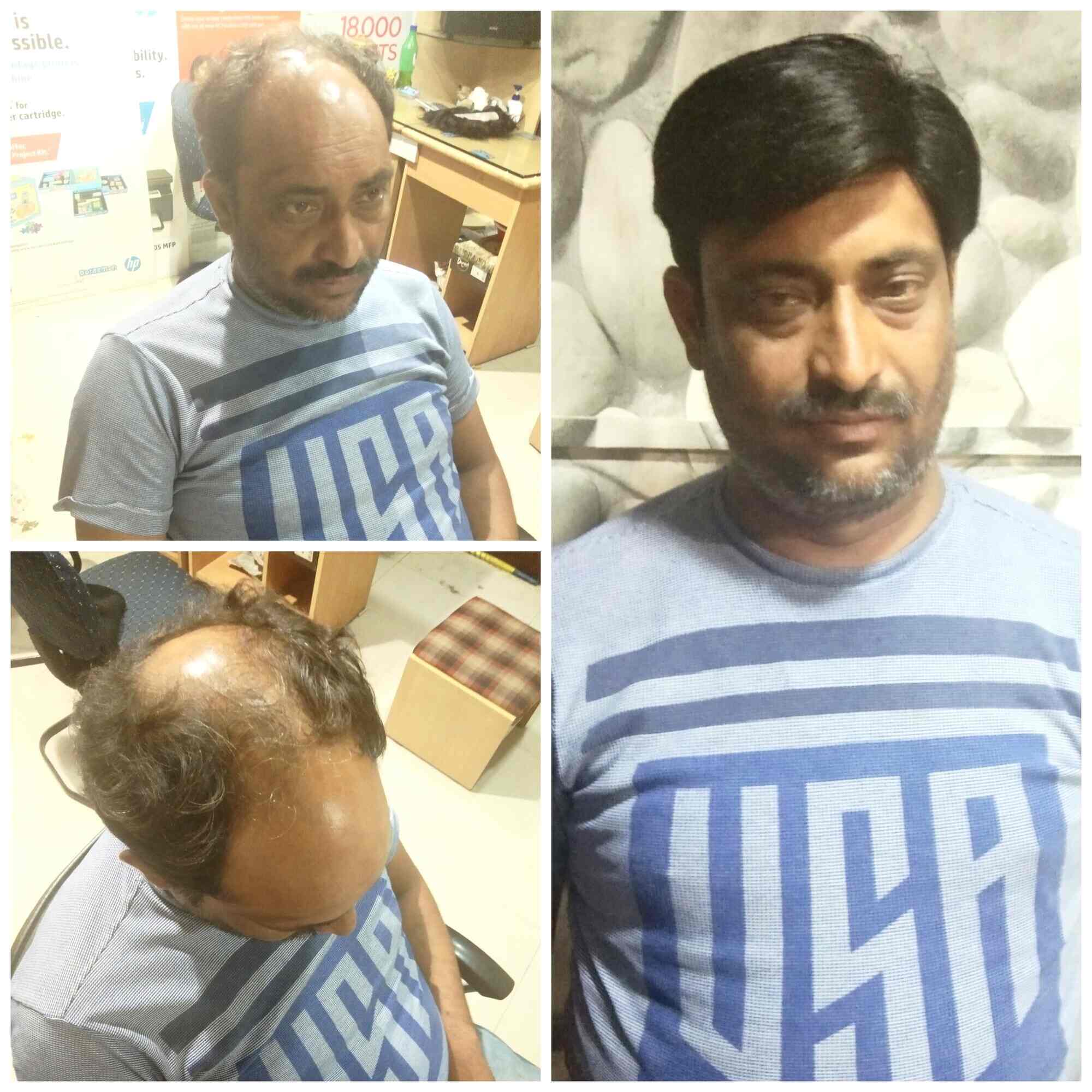 Discover more than 124 jaipur hair patch & wigs best ceg.edu.vn