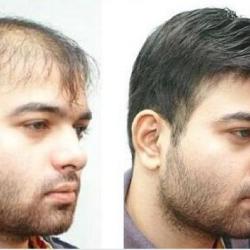 Rich Look Vaishali Nagar Human Hair Men Wig Dealers In Jaipur