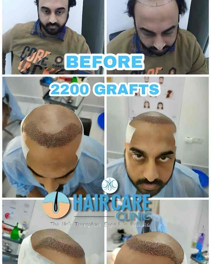 Top more than 66 hair transplant clinic in kolkata super hot in.eteachers