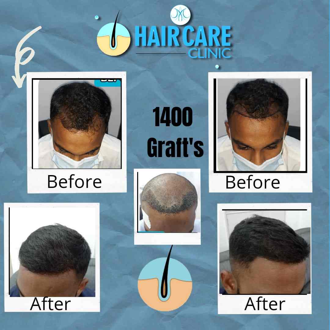 Top more than 131 best hair clinic in kolkata camera.edu.vn