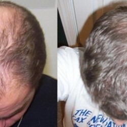 Vijaya Hair Clinic Hair Treatment Clinics Book Appointment