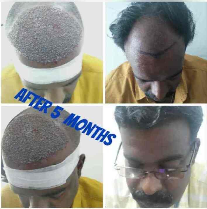 Details 148+ hair transplant in madurai super hot camera.edu.vn