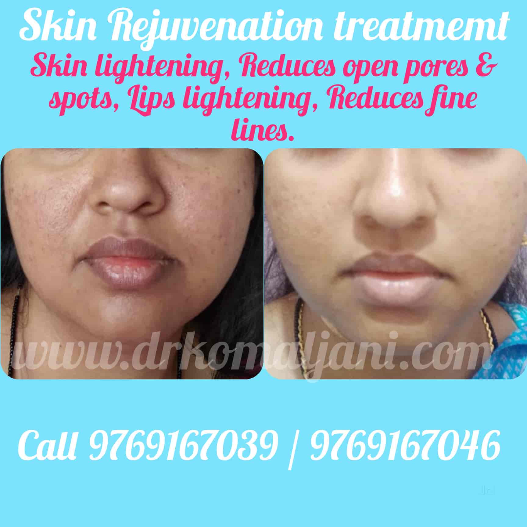 Top 90 + Face value hair transplant reviews polarrunningexpeditions