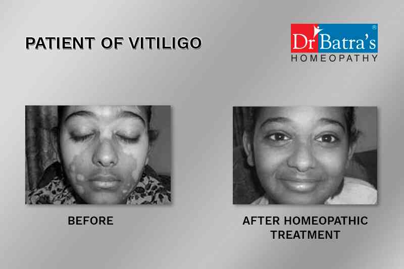 batra skin clinic near me