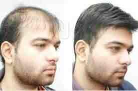 Hair Weaving Centre Vashi Beauty Parlours For Hair Bonding In