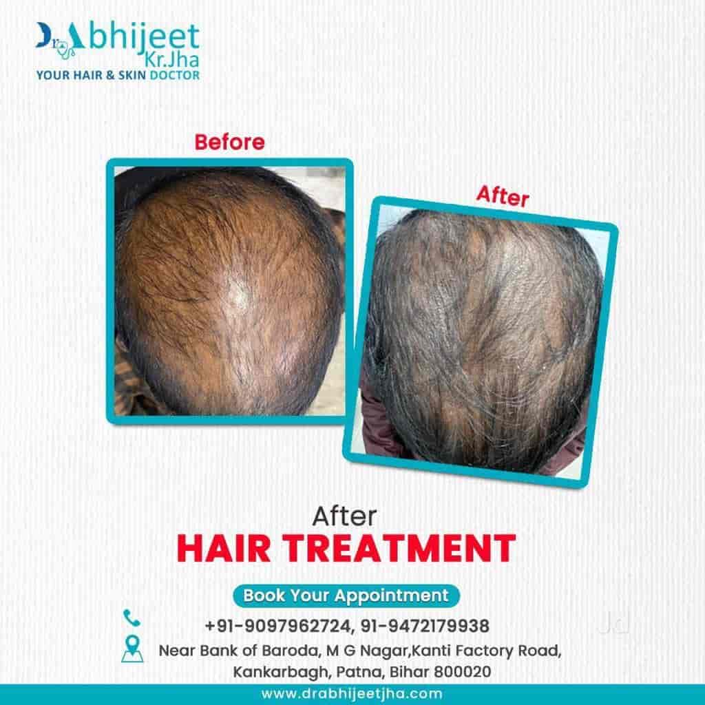 Discover more than 73 hair fall doctor in patna in.eteachers