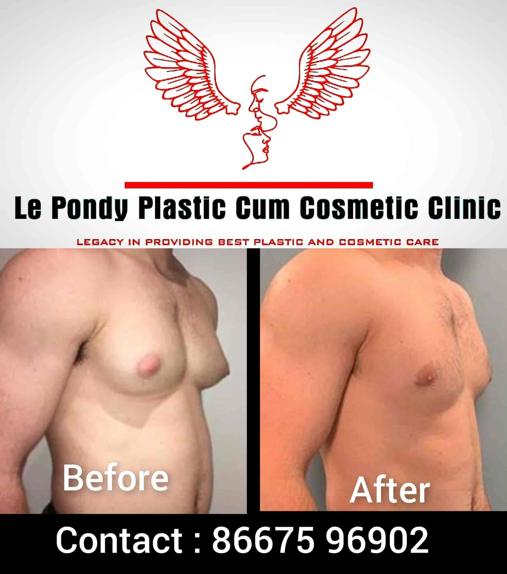 Before after cum Le Pondy Plastic Cum Cosmetic Clinic 2- Pondicherry in Chinnakadai,Pondicherry - 𝗕𝗼𝗼𝗸 𝗔𝗽𝗽𝗼𝗶𝗻𝘁𝗺𝗲𝗻𝘁 𝗢𝗻𝗹𝗶𝗻𝗲 - Best Clinics near me in Pondicherry - Justdial