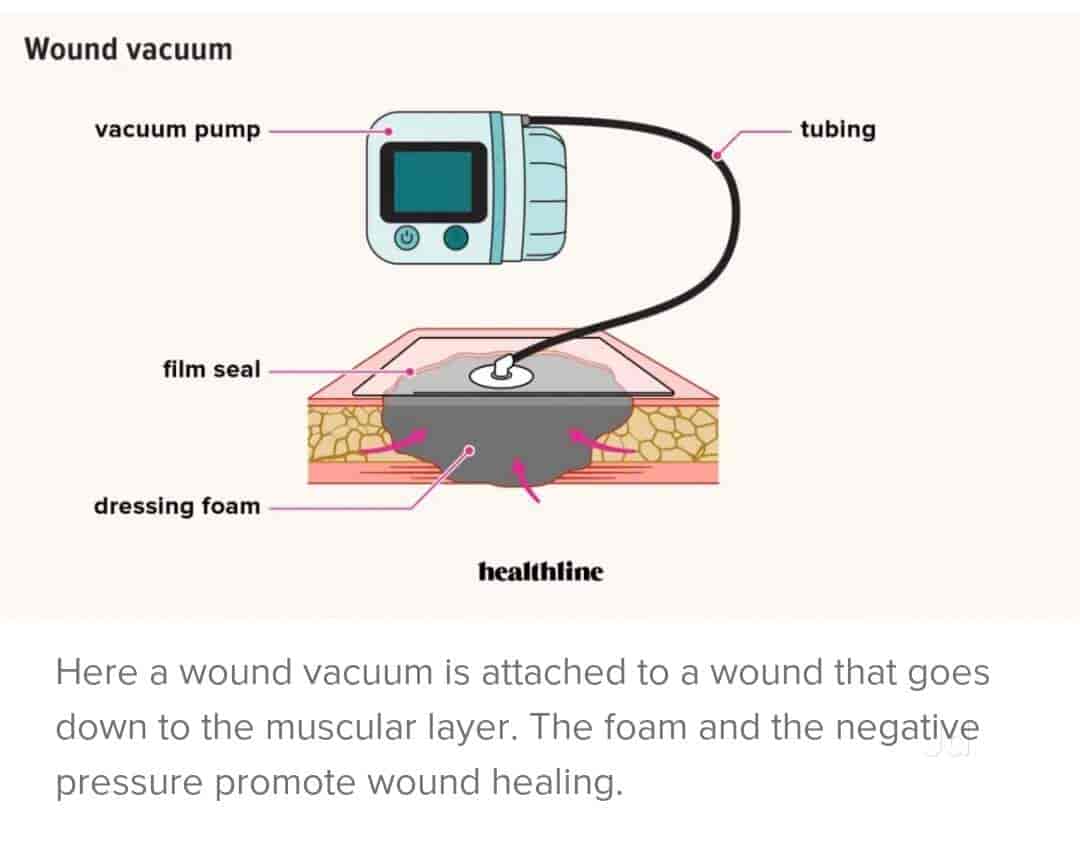 Wound Vac Dressing