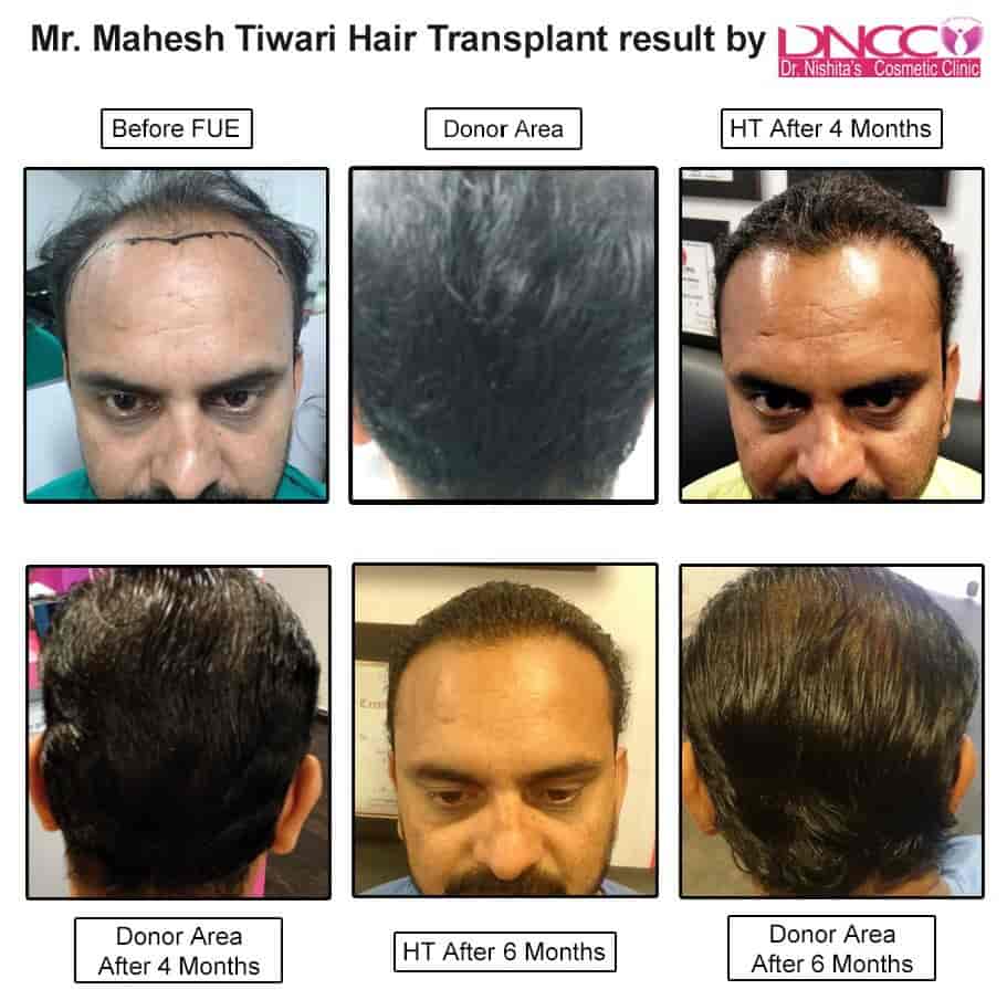 Discover 70+ hair transplant in rajkot best in.eteachers