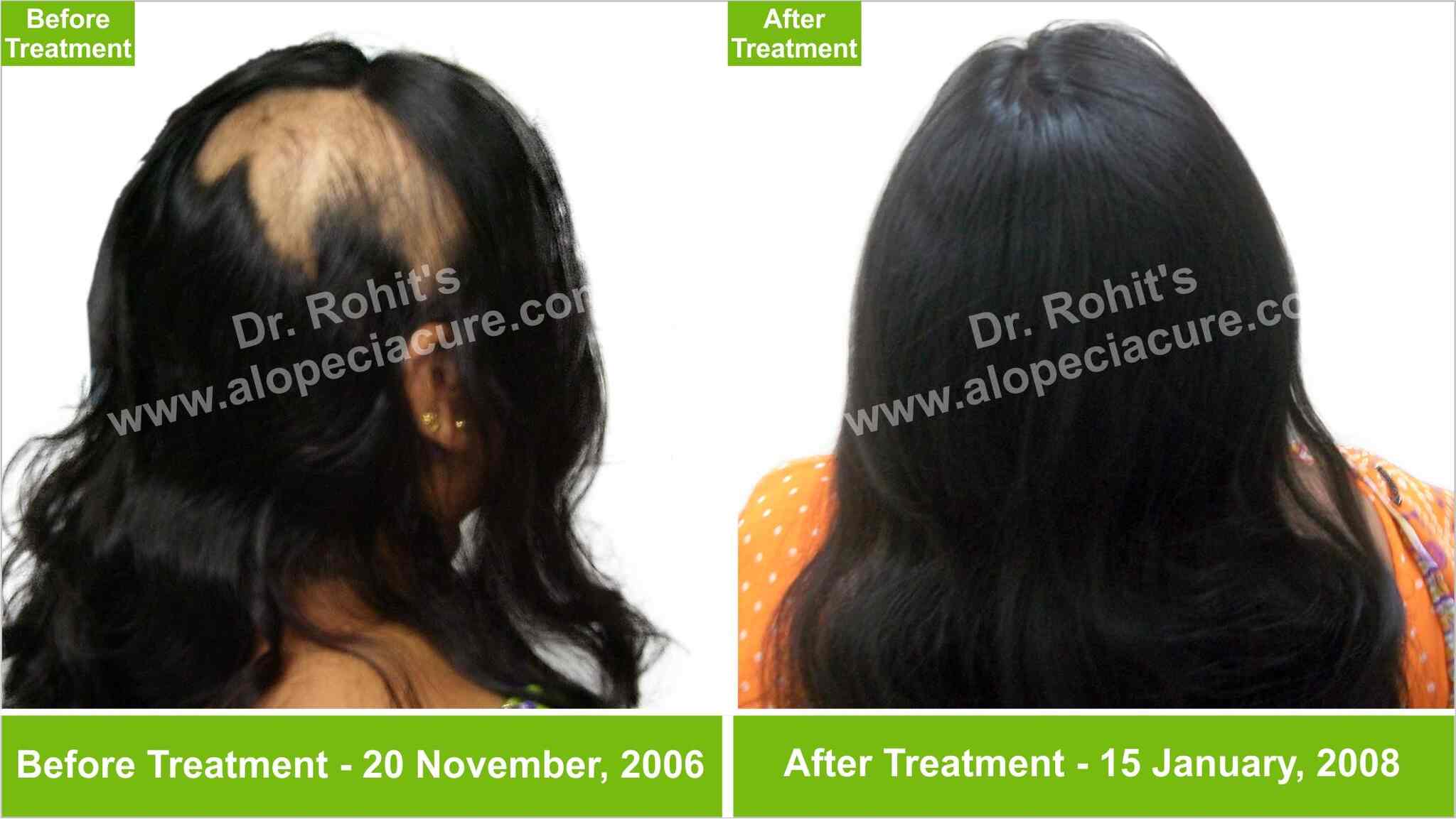 Alopecia Treatment Center Photos Gulbarga Pictures Images