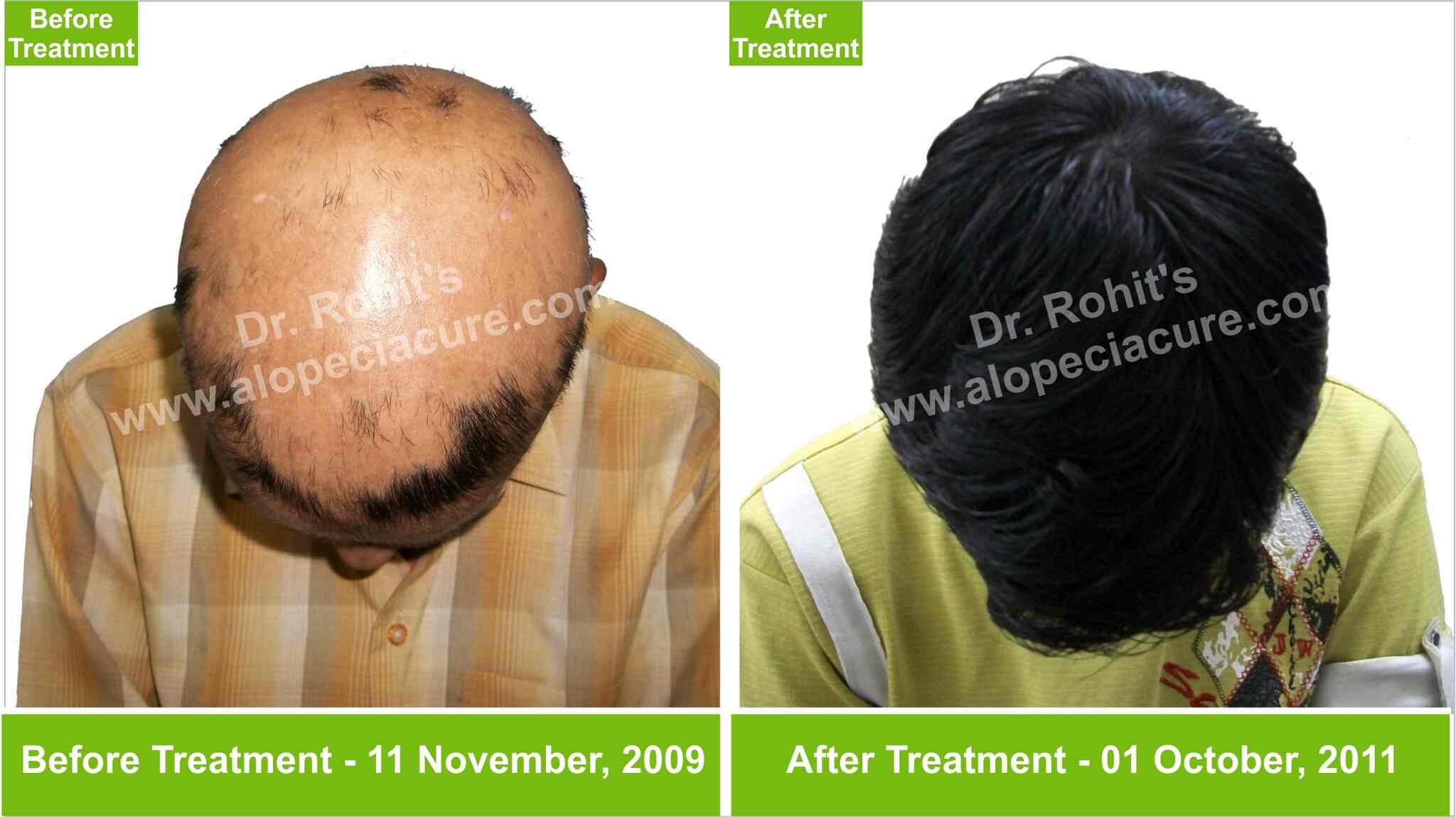Alopecia Treatment Center Photos Surat Ho Buxar Pictures