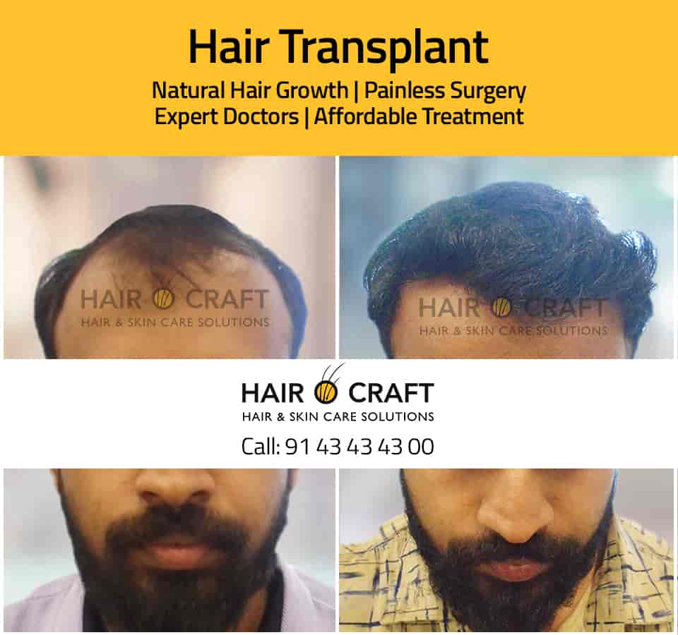 Discover more than 58 hair transplant in jabalpur latest in.eteachers