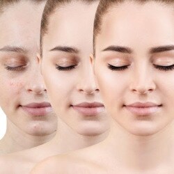 vcare acne treatment cost